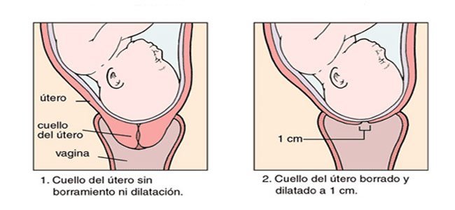 que significa que este borrado el cuello de utero